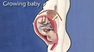 Factors that Contribute to GERD -- Pregnancy