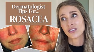 Dermatologist’s Guide to Rosacea: What Is It, Dos & Don’ts, Treatment Tips, & More! | Dr. Sam Ellis