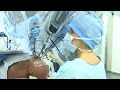 Une opération à l’aide d’un robot contrôlé par un chirurgien