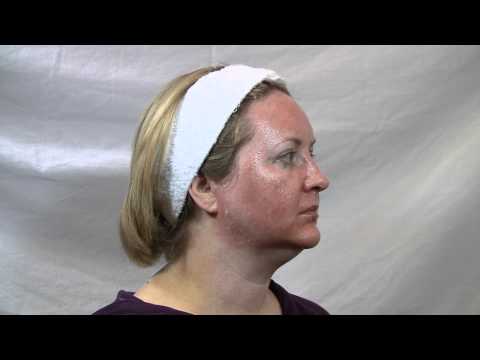 Fraxel Laser Demo Before & After Part 2