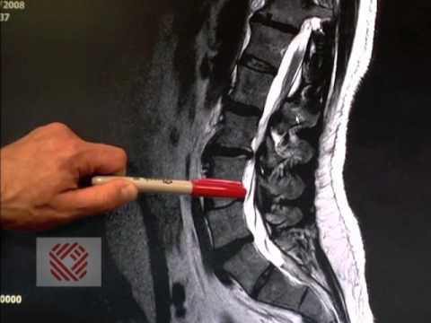 Wie die Puppe Bein im Hüftgelenk reparieren Schmerzen im unteren Rücken in den Sinus