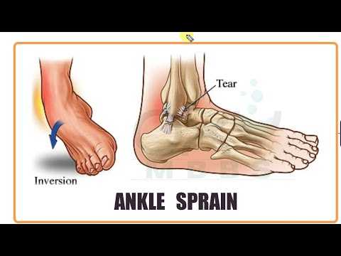 Hogyan kell kezelni a boka sprain kenőcsöt