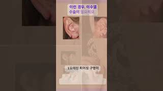 # 찢어진귓볼 #이수열 #귀걸이 “찢어진 귓볼을 꿰매는 게 아니라 '이렇게' 고칩니다!”