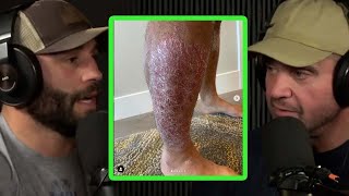 Chad Mendes Used Carnivore Diet to Heal Psoriasis