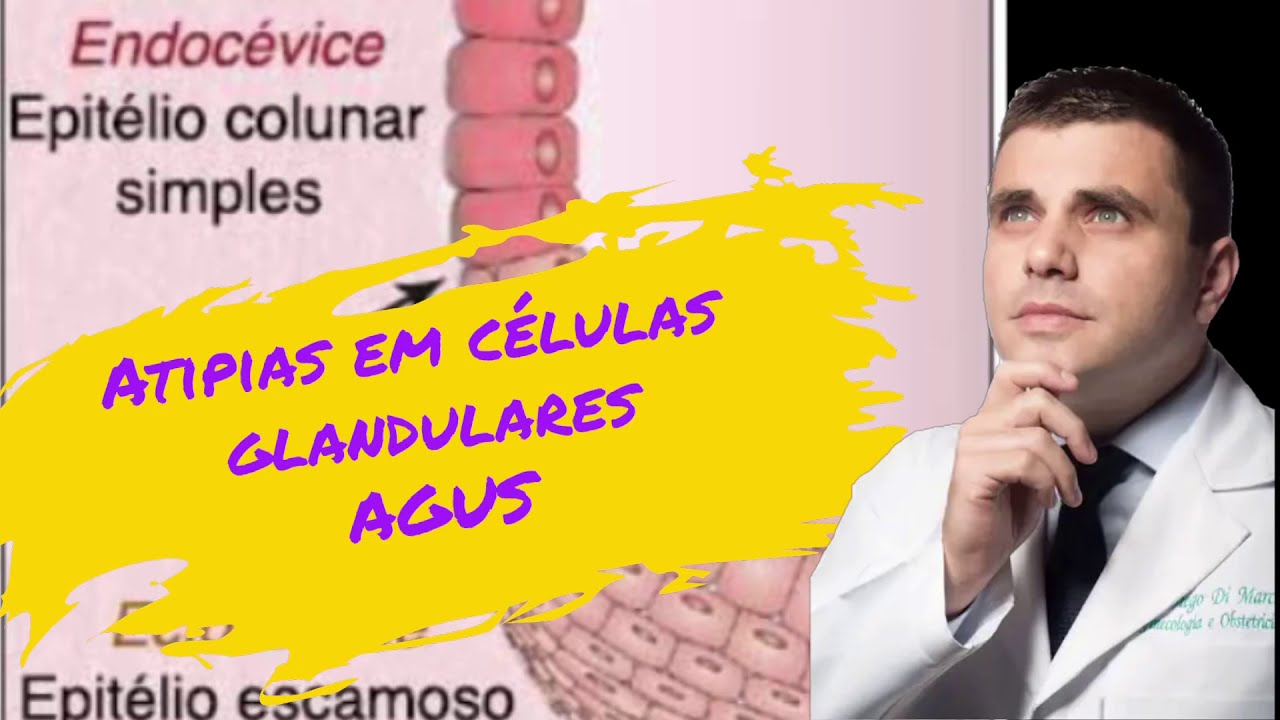 AGUS - lesão de células glandulares no Preventivo