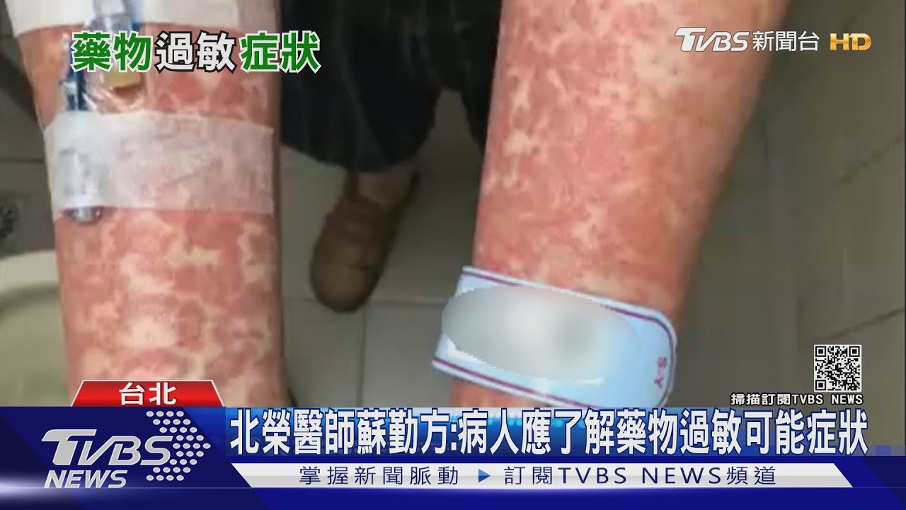 服藥後出現 這可怕「症狀」小心「藥物過敏」找上您
