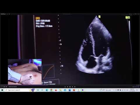 A video on volunteers demonstrating how to do advanced critical care Echo exam from 4 chambers view