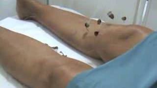 Acupuntura - Artrose (agulhas e moxabustão)