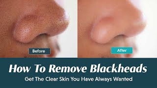 Best Ways To Remove Blackheads From Nose Easily