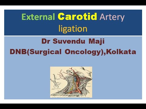 External Carotid Artery Ligation
