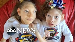 Kansas Parents of 2 Girls With Microcephaly Share Joys, Struggles of Family Life