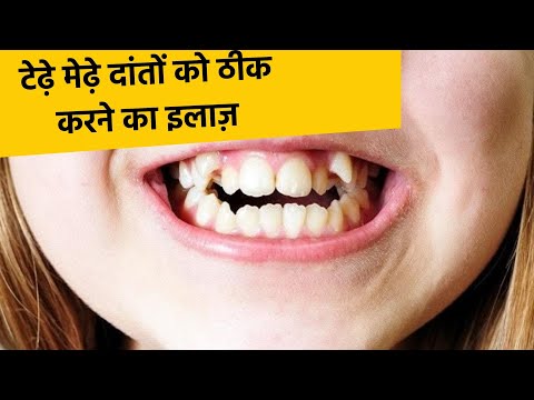 Straight teeth with braces