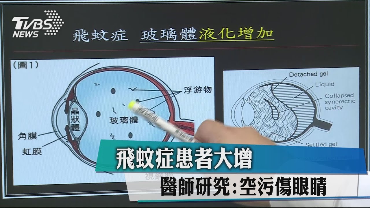 飛蚊症患者大增 醫師研究:空污傷眼睛
