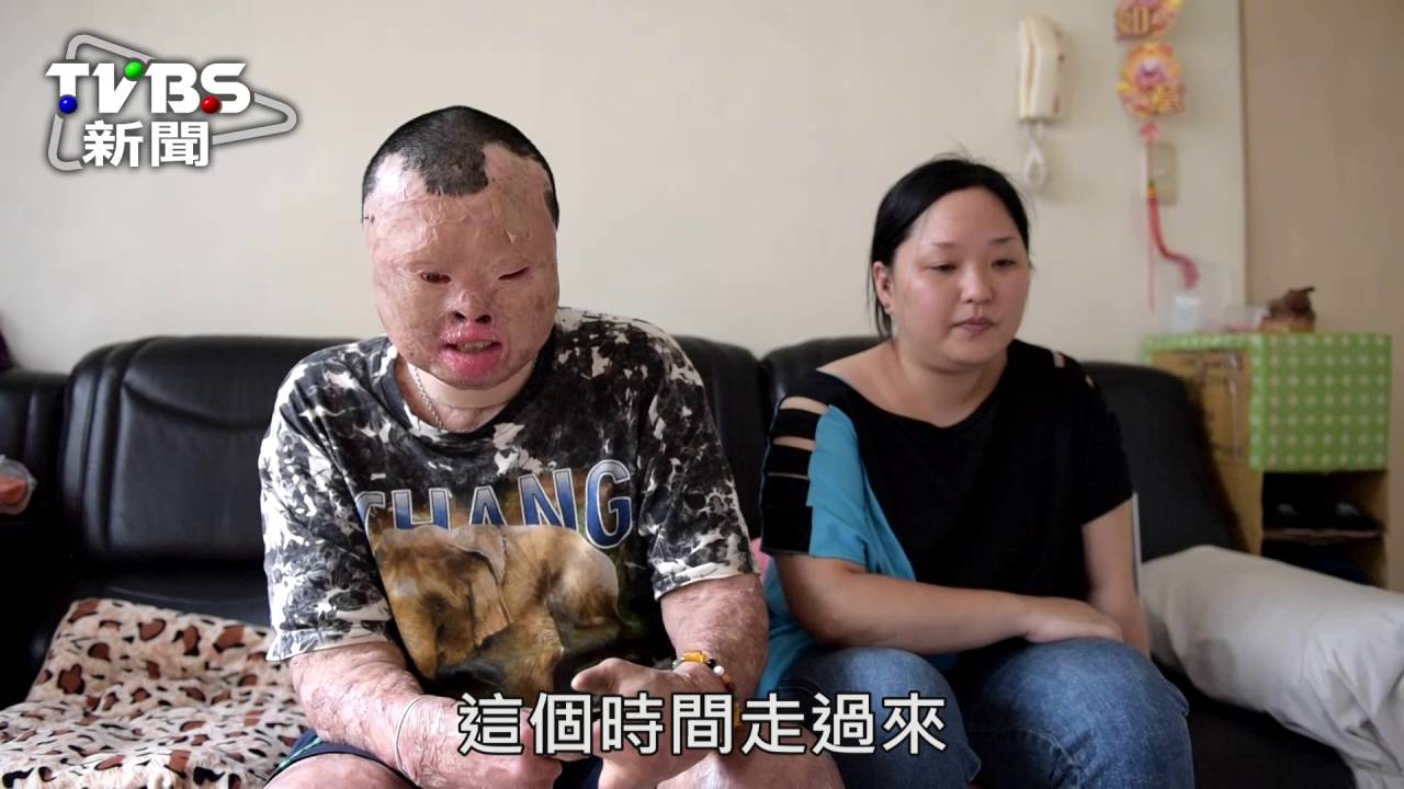 小角落正能量/被火紋身後 妻兒還在 我沒資格倒下去