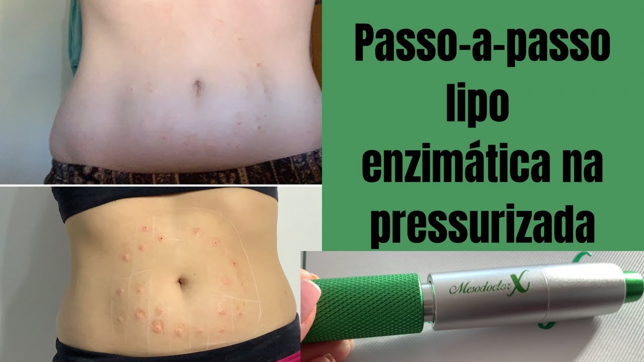 Lipo enzimática na pressurizada | Caneta pressurizada Mesodoctor X