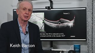 Macular oedema from prostaglandin agonists - don't forget!