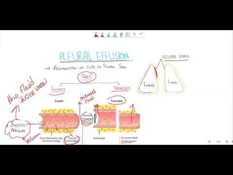Pleural effusion;Transudate vs exudate /Light criteria