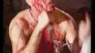 Haemorrhage-Mortuary Riot