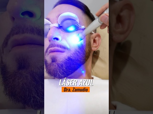 Vídeo relacionado con Tratamiento de varices con láser de luz azul, tratamiento de arañas vasculares con láser de luz azul, mejora la circulación sanguínea