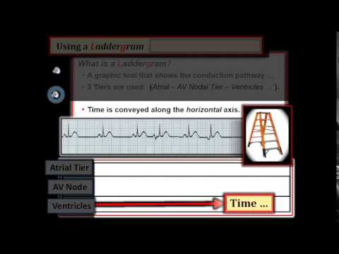 ECG Video-9 (Blog 110) - Is AV Block Complete? / Laddergram Primer