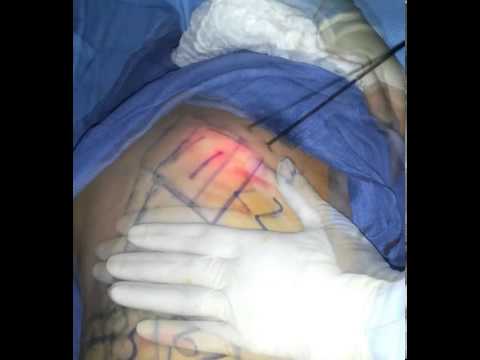Kung magkano ang kailangan mong kumain ng suha isang araw para sa pagbaba ng timbang I-wrap slimming coffee sa bahay honey