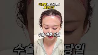 모발이식 (FUE) 성형 시술