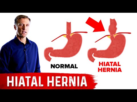 Hiatal Hernia: The Best Home Treatment
