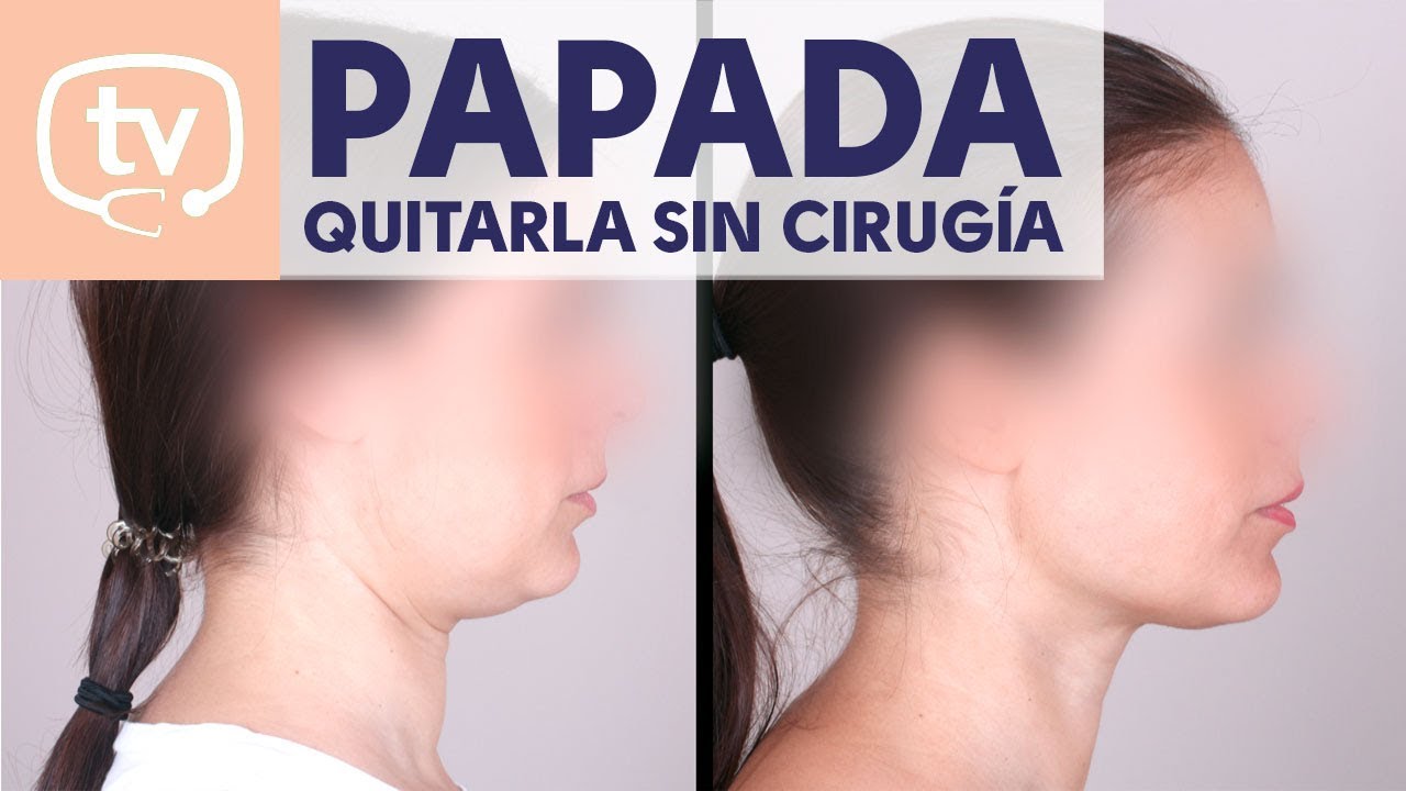 ¿Cómo eliminar la papada sin cirugía