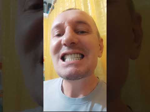 Система All on 4. Не съёмные протезы. Удалил все зубы в количестве 21 штук.