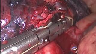 VATS right upper lobectomy, fissureless. lobectomia superior derecha toracoscopia VATS - Antonio Francisco Honguero Martínez