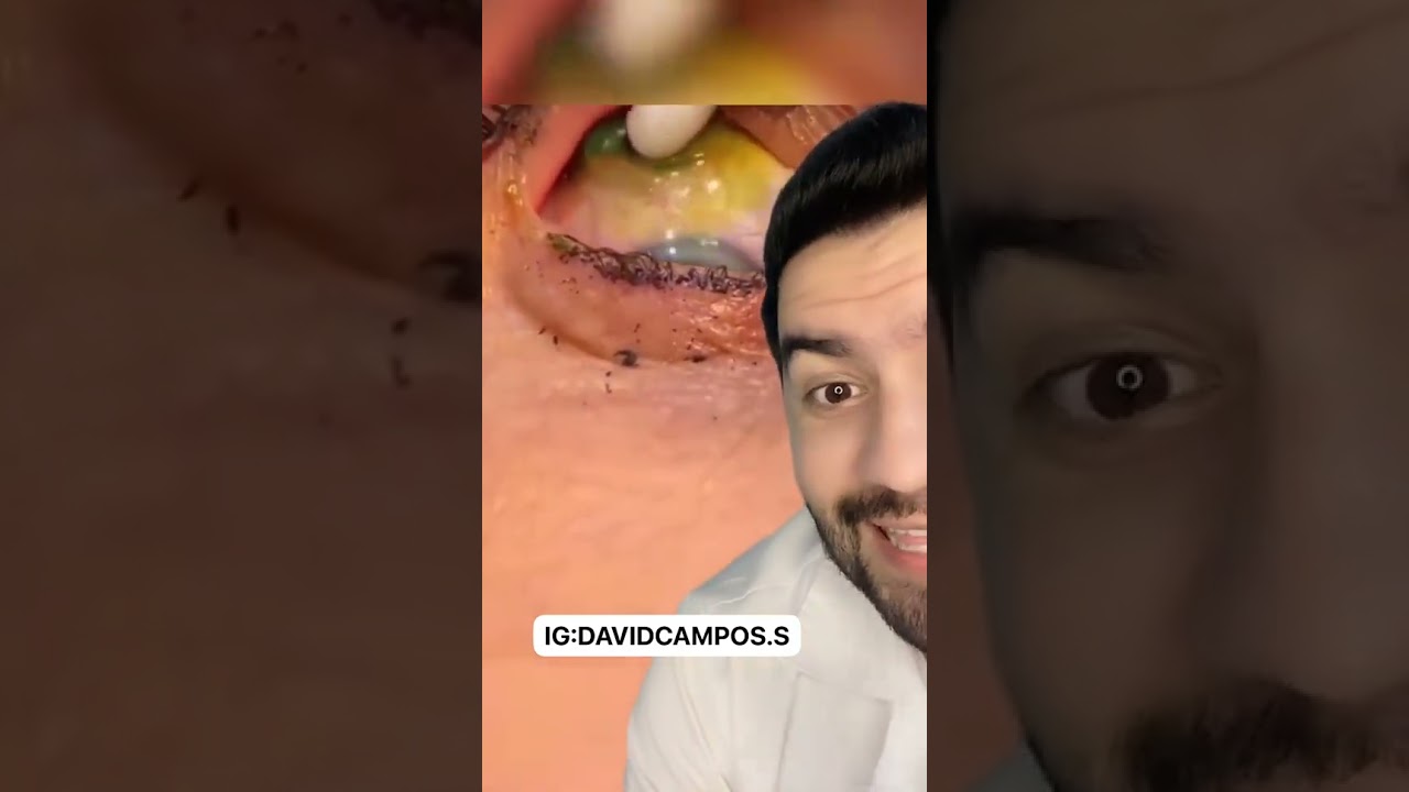 SE METIO 23 LENTES DE CONTACTO EN EL OJO