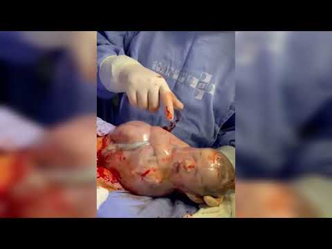 , title : 'Bayi Baru Lahir Selalu Nangis Saat Pertama Bernafas di Dunia! | Hasil persalinan lewat operasi |'