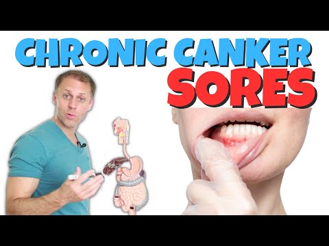 Dealing with Chronic Canker Sores