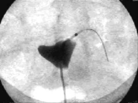 Opening a fallopian tube