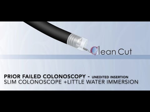 Coloscopie du rectum au caecum sous un minimum d'eau: coloscopie préalable difficile