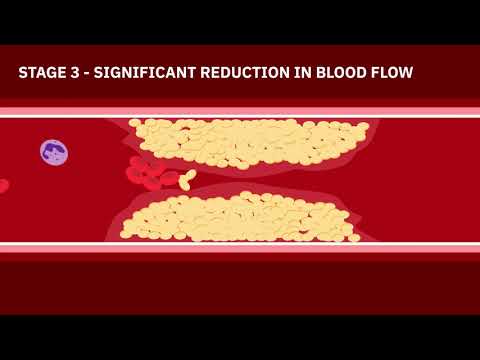 Coronary Artery Disease Animation