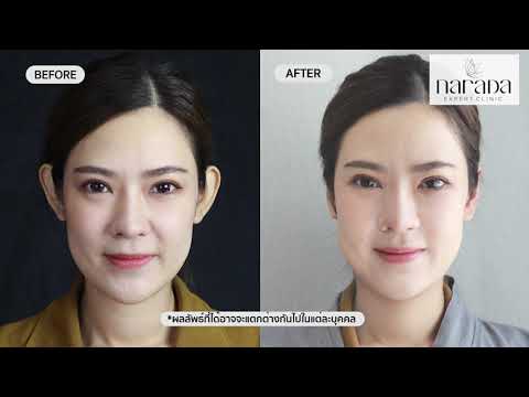 แก้หูกางถาวร แบบไร้แผลเป็น | By. Narada Clinic แก้หูกางถาวร แบบไร้แผลเป็น | By. Narada Clinic