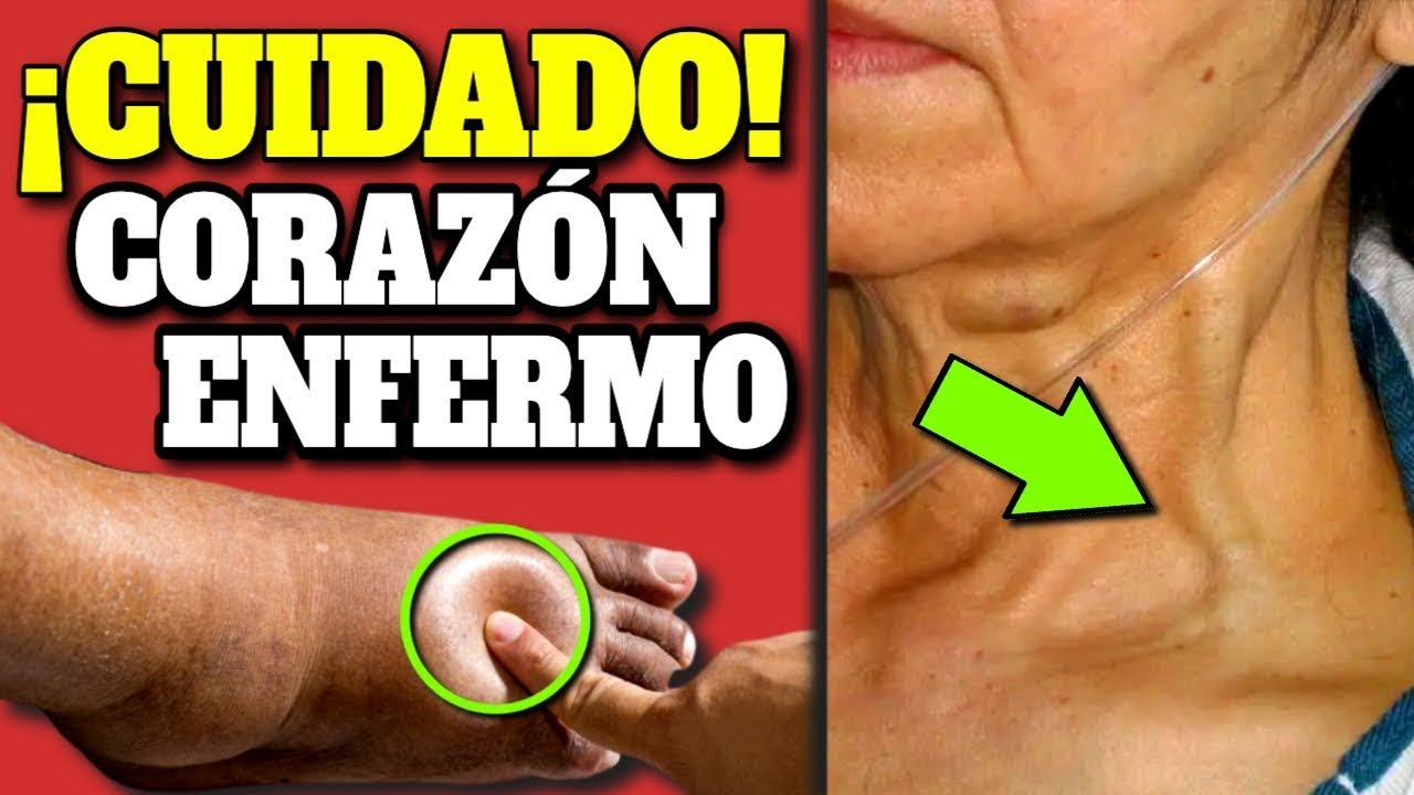 ¡ALERTA! SIGNOS de ALARMA de CORAZÓN GRANDE y DEBIL| SÍNTOMAS de que tu CORAZÓN NO FUNCIONA BIEN