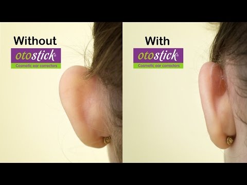 New  Otostick Cosmetic Ear Correctors | A solution for prominent ears