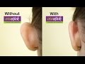 New  Otostick Cosmetic Ear Correctors | A solution for prominent ears
