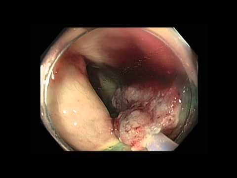 Colonoscopy of Rectum: LST Nongranular Tumor 