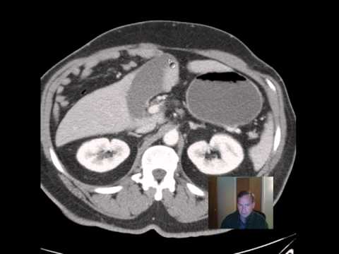 CT Hernia with Ischemic Bowel discussed by RADIOLOGIST