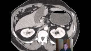 CT Hernia with Ischemic Bowel discussed by RADIOLOGIST CT Hernia with Ischemic Bowel discussed by RADIOLOGIST