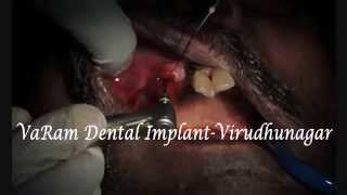 preview picture of video '3rd Part Flapless Spiral Implants In Anterior Upper Arch Rehab-VaRam Dental Virudhunagar'