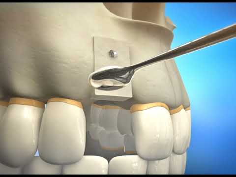 Bone Grafting Procedure Video Animation | Durham Dental Solutions