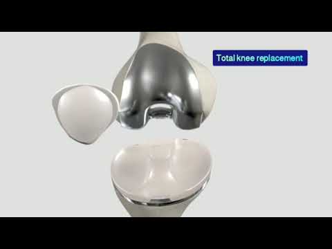 Total Knee Replacement Surgery Simple