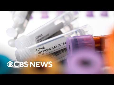 Study finds possible lupus cause, way to reverse disease