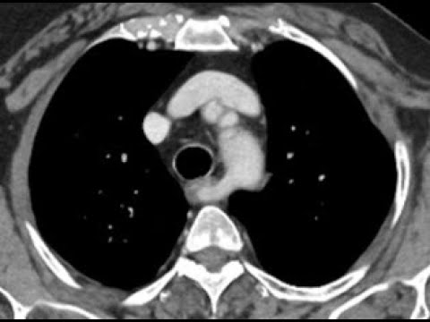 Artéria subclávia direita aberrante na tomografia de tórax