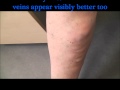 Severe superficial thrombophlebitis  before and 48 hours after treatment