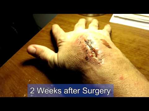 Warning Graphic! Huge Ganglion Cyst Popping and Removal!